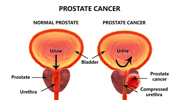 Prostate Enlargement